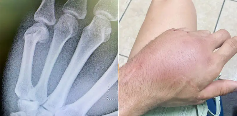Josep Garcia Blessure main casse